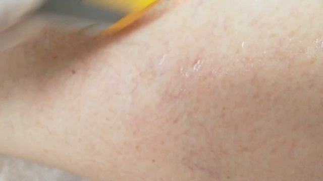 Лазерное удаление сосудов на коже ног и лица