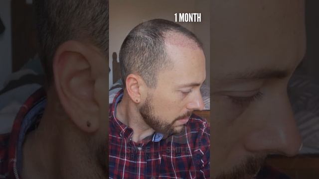 Hair Transplant Before and After of Matthew! 6 MONTHS / 5000 Grafts