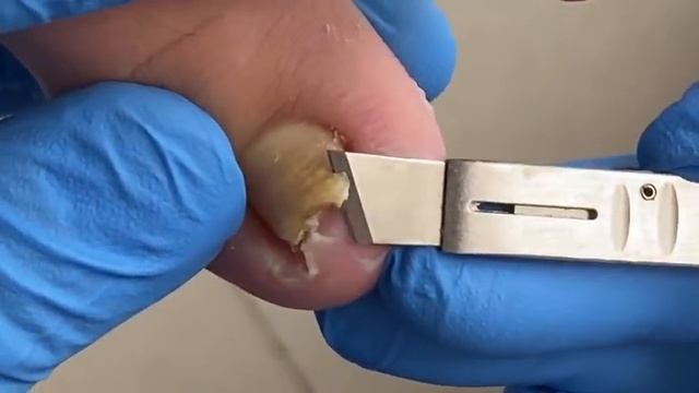 Pedicure tutorial: huge ingrown nails, carefully trimmed【Xue Yidao】