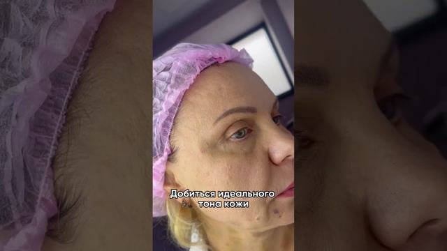 Беспроигрышный способ борьбы с пигментацией