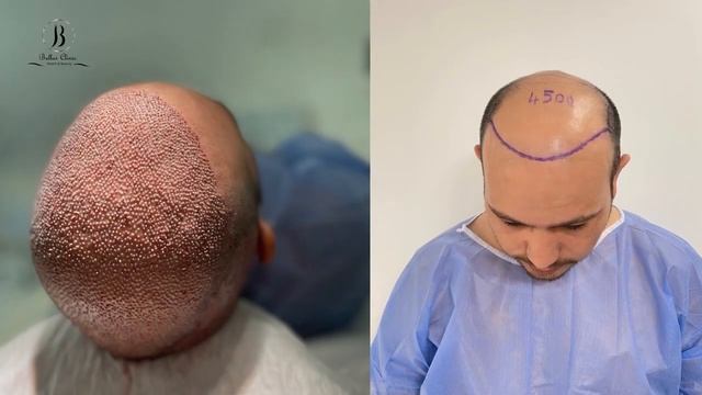 hair transplant in Bellus clinic / 5600 grafts per one session