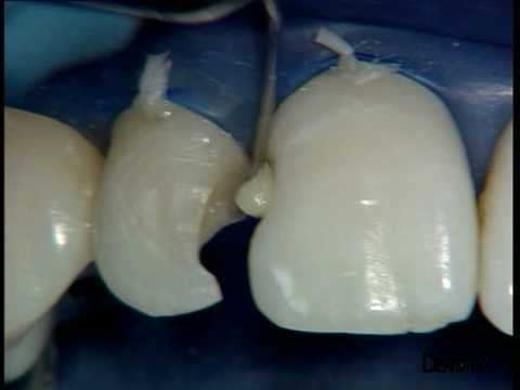 ceram-x-duo-III-IV-part1.mpg