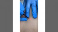 Лазерное удаление образований в процессе