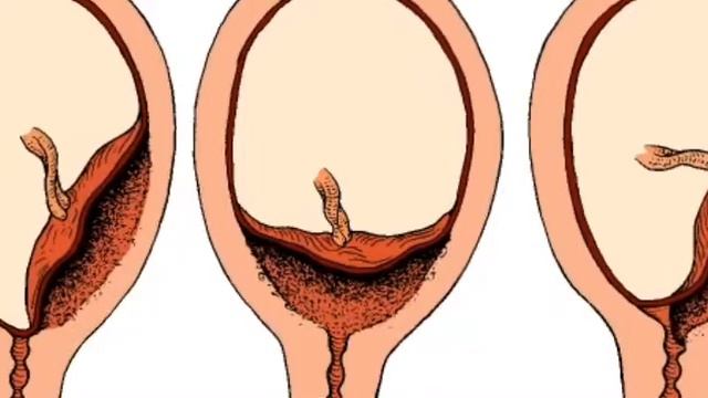 ENDOMETRIT QANDAY KASALIK? HAMMA AYOLLAR KO'RSIN!
