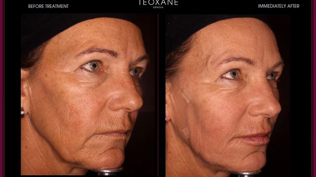 See the results of Dr Sebagh demonstrating threads & fillers, Teoxane Ways of Beauty