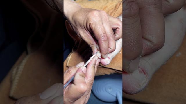 Chinese professional pedicure/tickle feet/Ingrown/nails/레 푸스/#Ingrown #Pedicure #toenails 412【ASMR】
