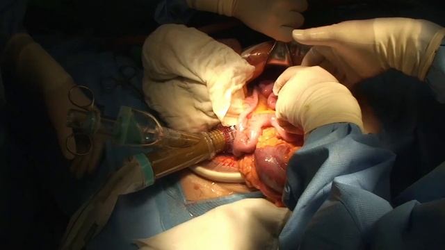 intraoperative colonic irrigation for colon cancer obstruction surgery