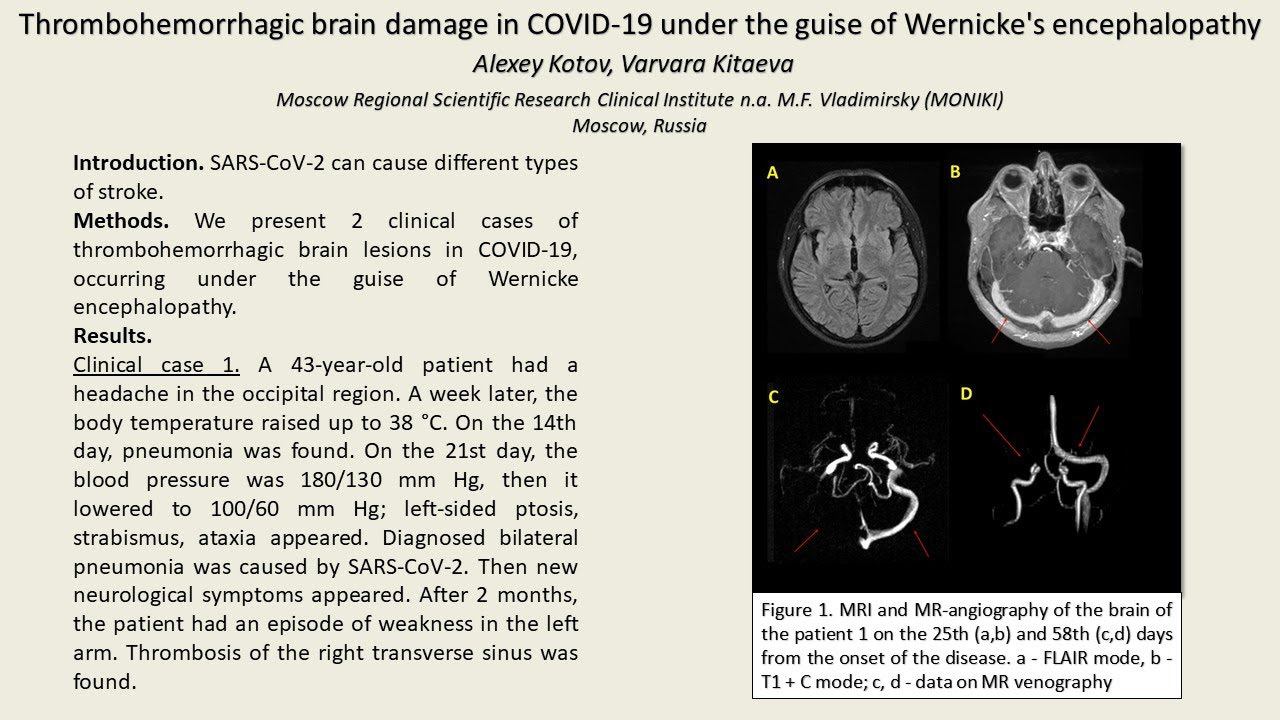 Thrombohemorrhagic Brain Damage In COVID 19 Under The Guise Of Wernicke's Encephalopathy