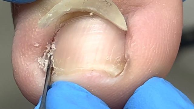 Inflamed toenails trim excess ingrown nailsXue Yidao Pedicure