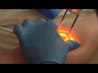 Лечение лазером варикозное расширение вен