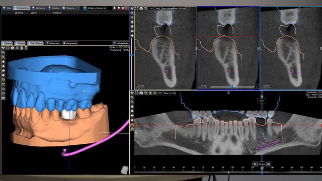 3Diagnosys и PlastyCAD - планирование одиночного имплантата+ хирургического шаблона