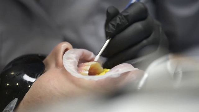 Художественная реставрация зубов в Киеве на Печерске. Изменение улыбки при помощи композитных винир