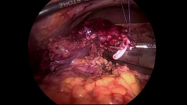 Laparoscopic GastricDuodenal-1 resection in large perf Du ulcer: Operator S Di Saverio MD FACS FRC