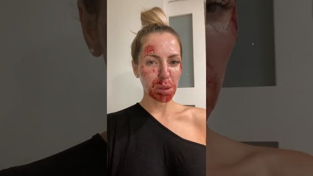 Fatona laser resurfacing
