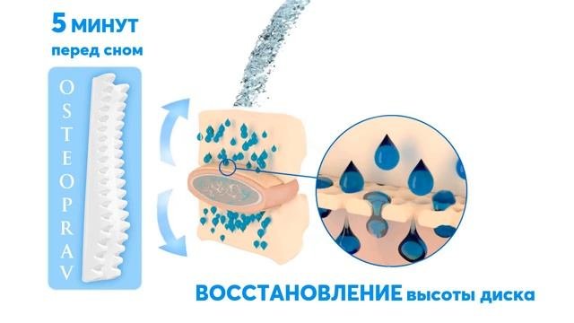 Восстановление высоты межпозвонкового диска с помощью тренажера-массажера OSTEOPRAV