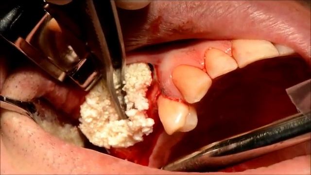 Sinus Lift - Caldwell Luc approach with PRGF Endoret