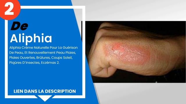 Les 3 meilleures crèmes pour la dermatite atopique