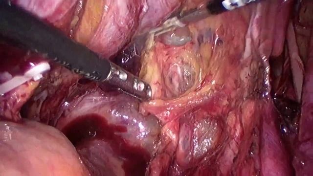 Laparoscopic anterior exenteration, Bricker LIVE _ Лапароскопическая цистэктомия.mp4