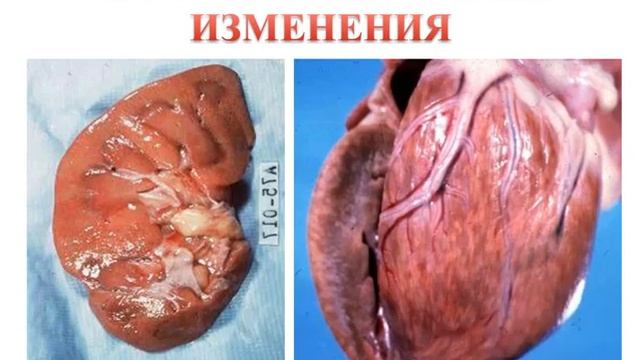 Зернистая дистрофия