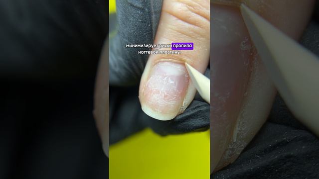 Как избежать пропилов ногтевой пластины