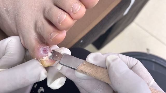 Toes Skin Burst , Quickly Remove Dead Skin!【Foot scalpel】