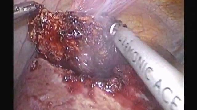 Lap metastasectomy from II-III seg for colorectal cancer Mts