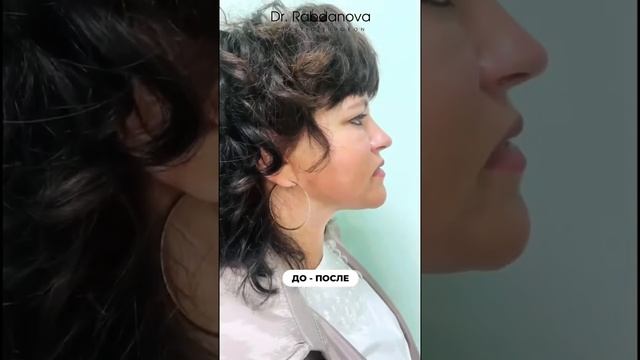 Подтяжка лица и шеи + Нижняя блефаропластика + Липофилинг носогубных складок и средней трети лица