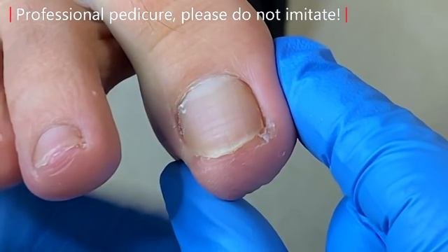 Pedicure Tutorial: Short Nails Are More Difficult To Trim, Pull Out Ingrown Nails【Xue Yidao】