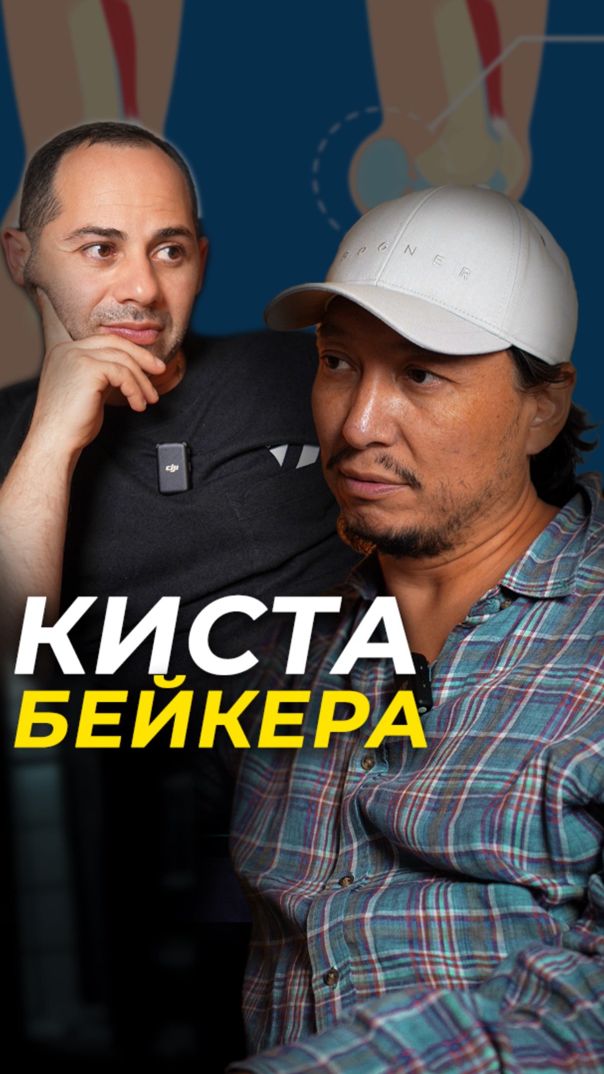 КИСТА БЕЙКЕРА