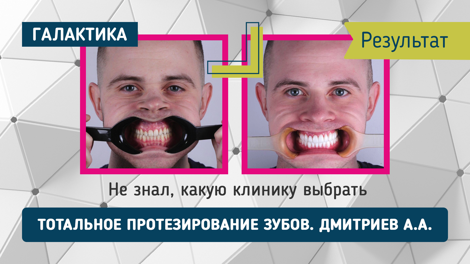Тотальное протезирование зубов | Дмиртиев Александр Александрович