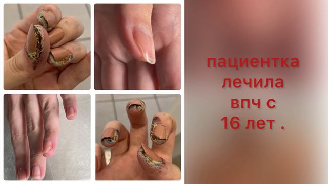 Залипательное видео динамик грибка ногтей / Лечение грибка ногтей / ДО и ПОСЛЕ #москва #ногти