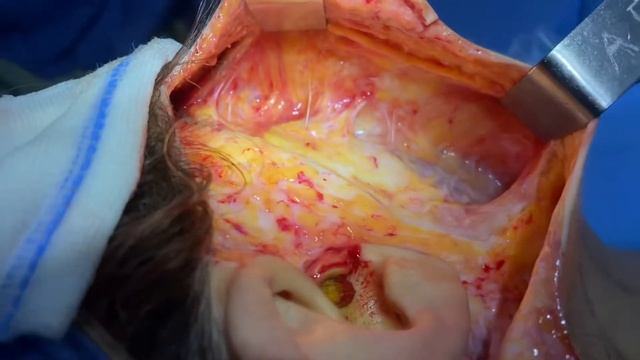 Deep Plane Facelift Surgery complete composite deep plane dissection.