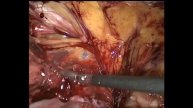 TAPP Laparoscopic Hernia Repair using Glue. Клеевая ТАРР при большой паховой грыже
