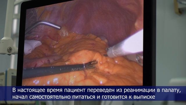 В Клинике факультетской хирургии № 2 Сеченовского Университета провели  сложнейшую операцию
