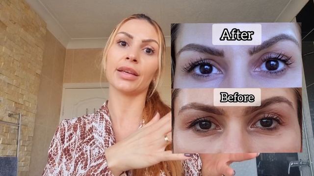 Results Hifu Face Lift / Part 2 #hifu #facelifting