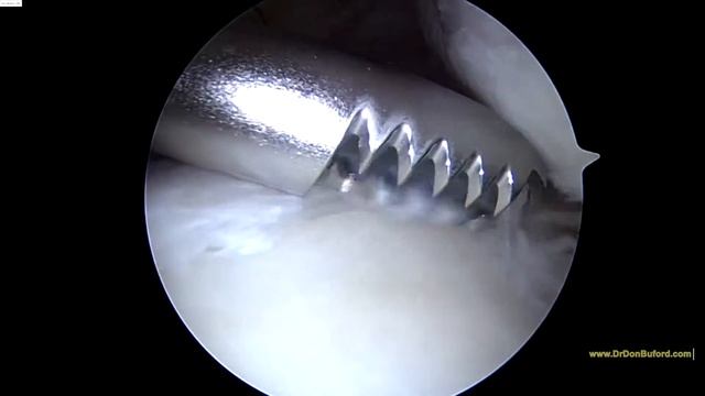 Left Shoulder Biceps Tenodesis (axillary Incision) HB 9152016