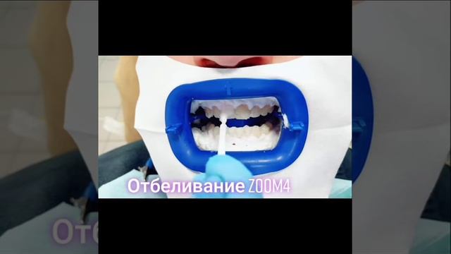 Отбеливание зубов ZOOM-4.