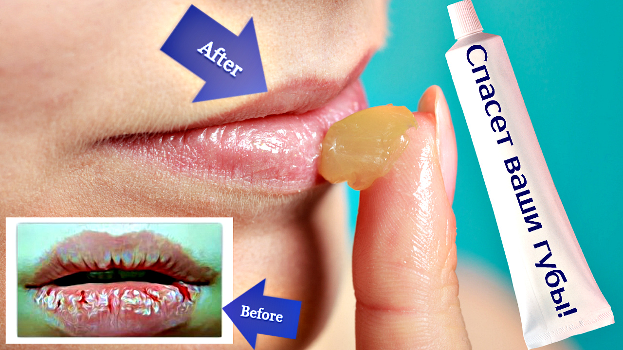 Это аптечное средство в миг вылечит ваши обветренные губы. Чем мазать обветренные губы?