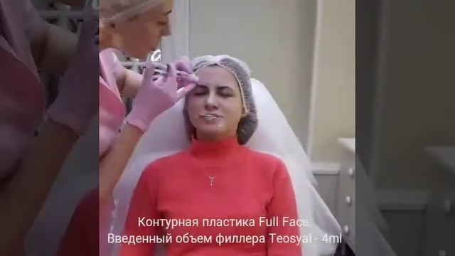 Full Face. Контурная пластика.