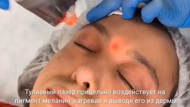Фракционный лазер ResurFX