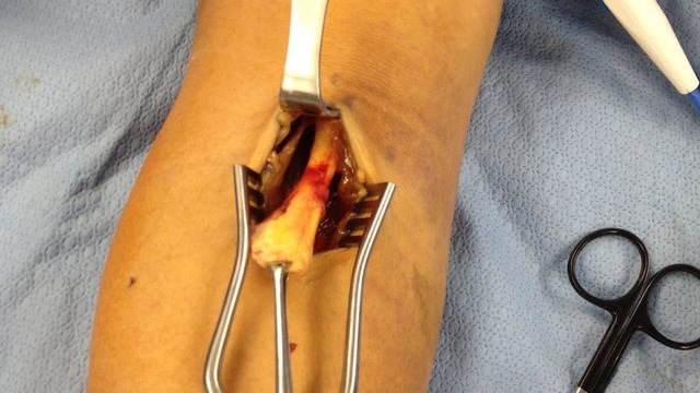 Distal Biceps Tendon Rupture: Mechanism Of Injury And Treatment