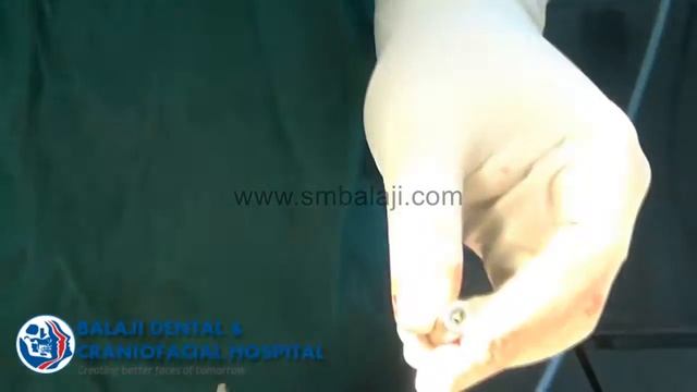 Sinus Lift with Immediate Implant Placement and Bone Grafting