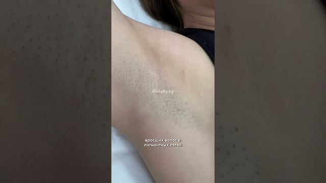Перед свадьбой решила пройти курс лазера и была в шоке ??