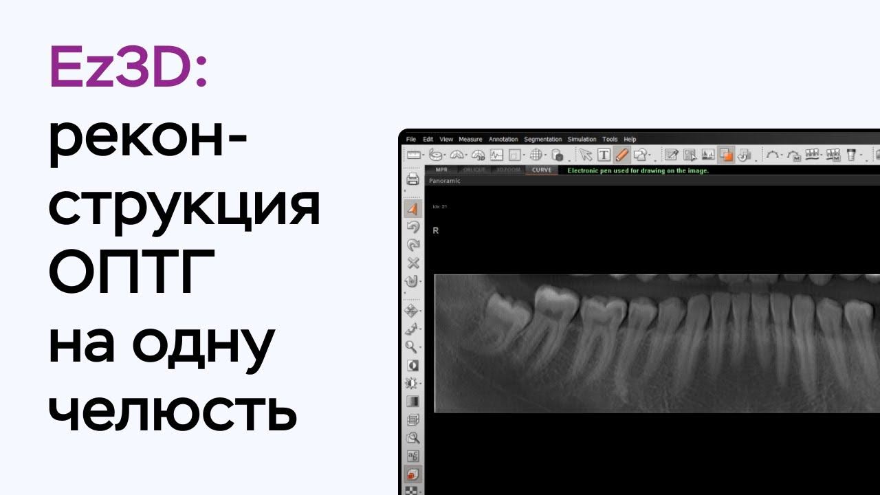 Возможности программы Ez3D: реконструкция ОПТГ на одну челюсть