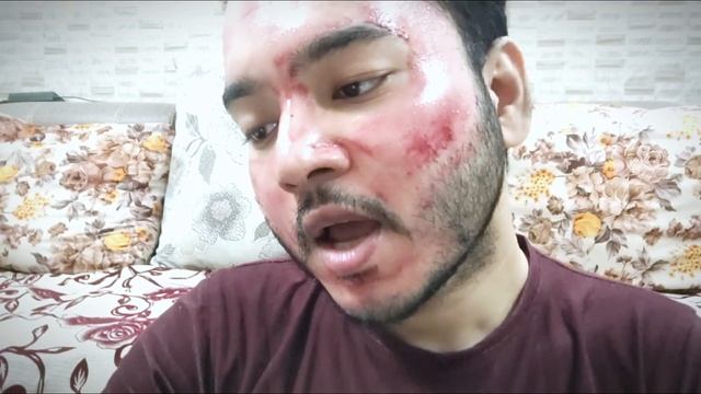 The Ordinary AHA 30% + BHA 2% chemical Peeling Solution full process and review