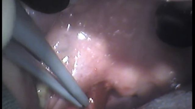 Tonsillectomy Qantum
