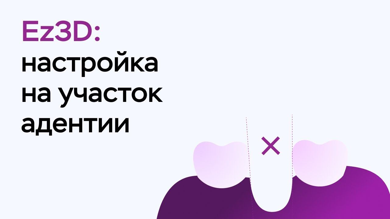 Возможности программы Ez3D: настройка на участок адентии