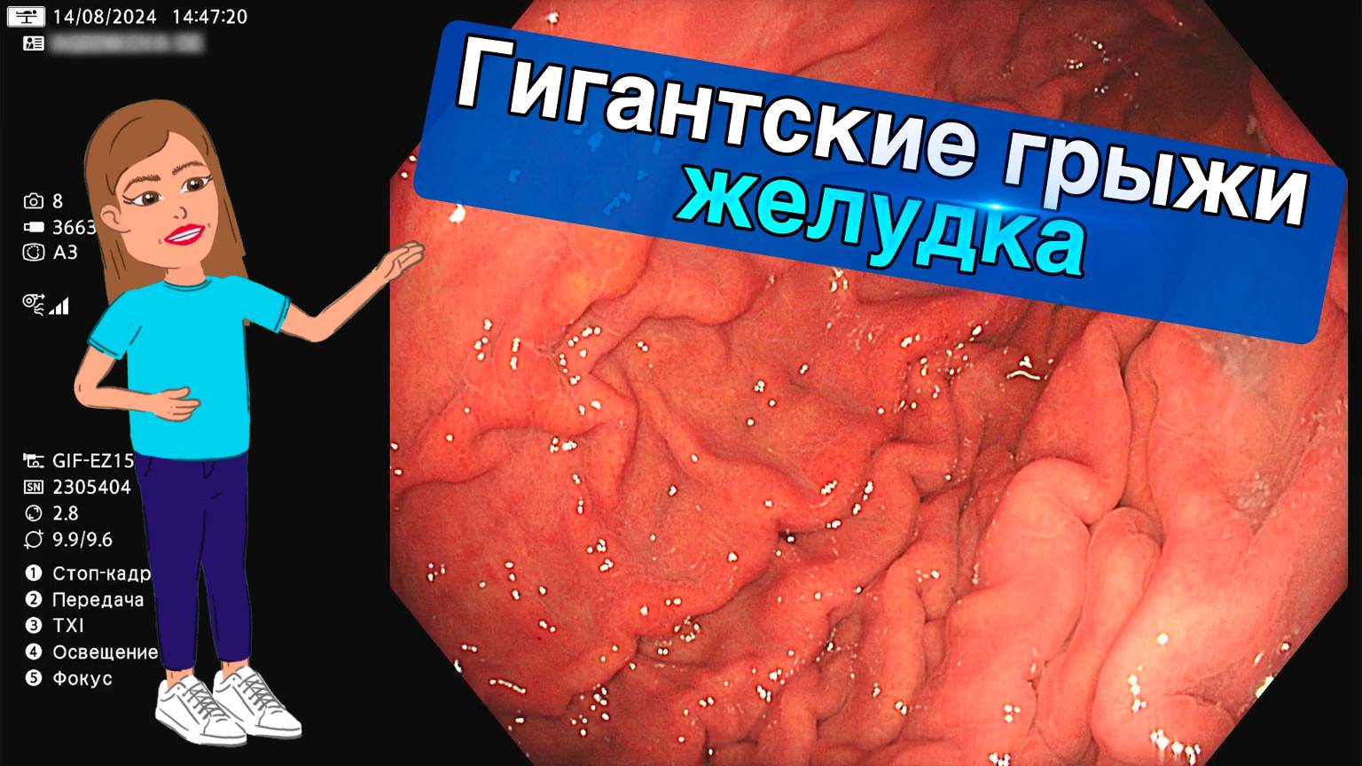 Гигантские грыжи желудка | Клинический случай