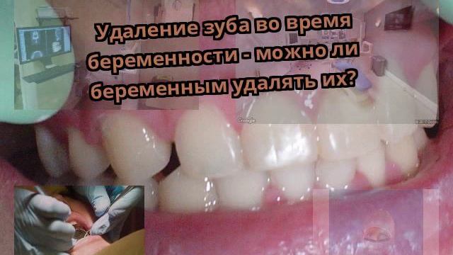 Удаление зуба во время беременности - можно ли беременным удалять их?
