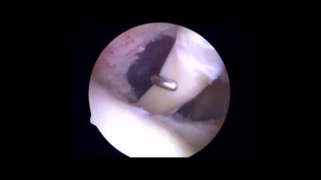 Consolidated Proximal Biceps Tenodesis and Subscapularis Repair